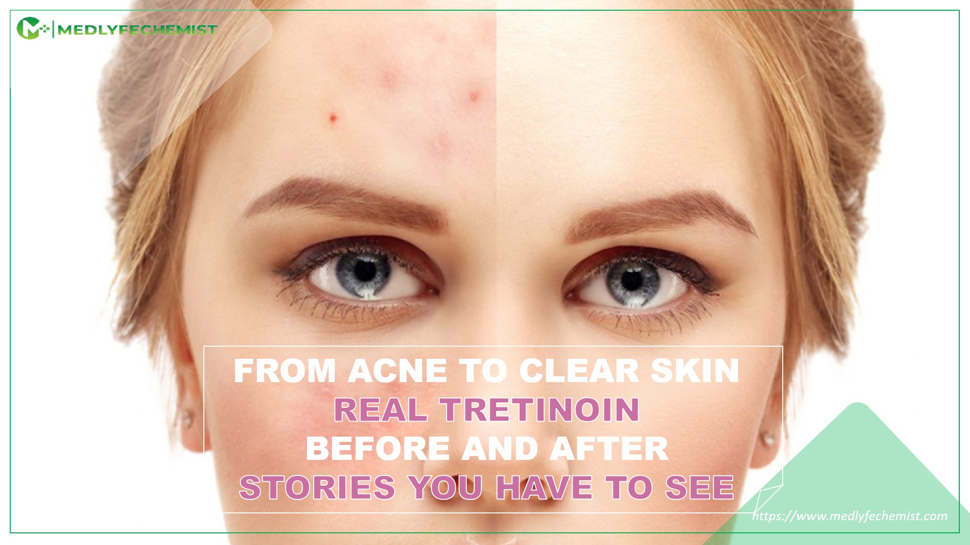 From Acne to Clear Skin: Real Tretinoin before and After Stories You Have to See